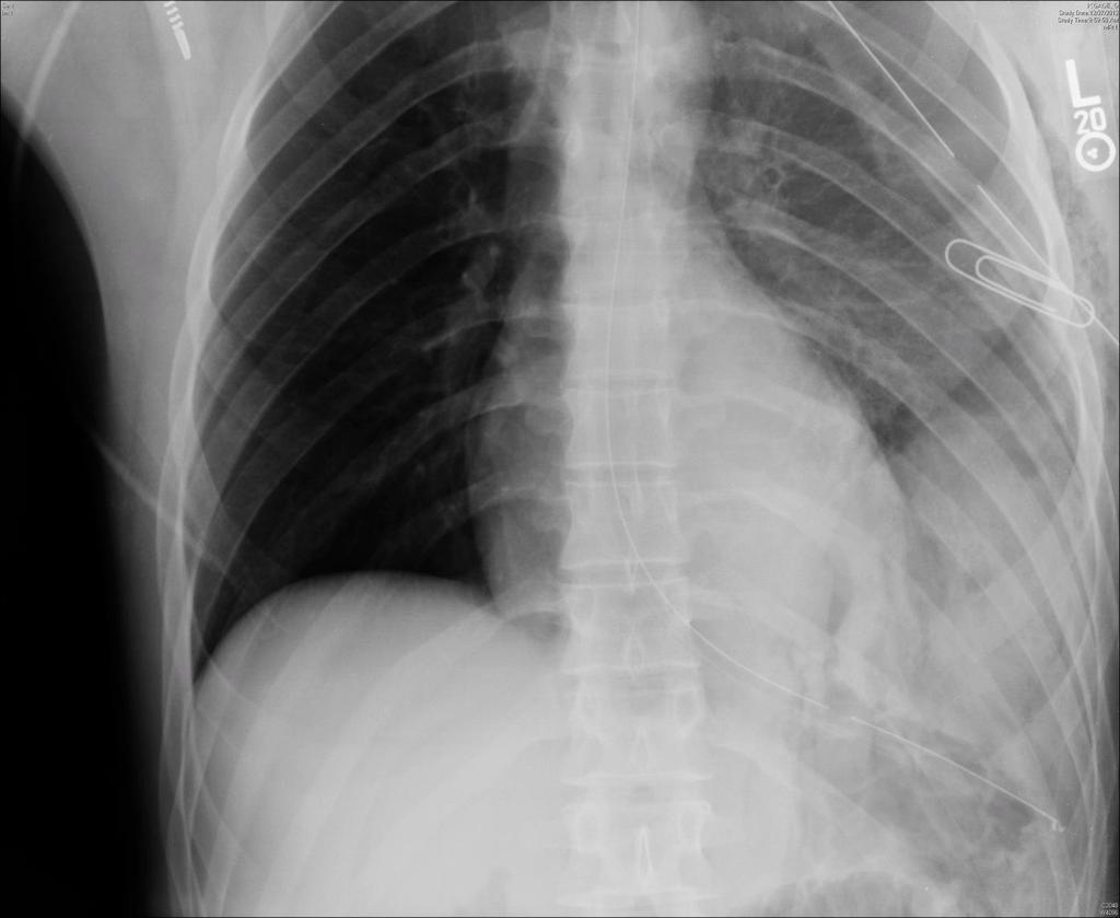 Patient was stabbed. Is there diaphragmatic injury?