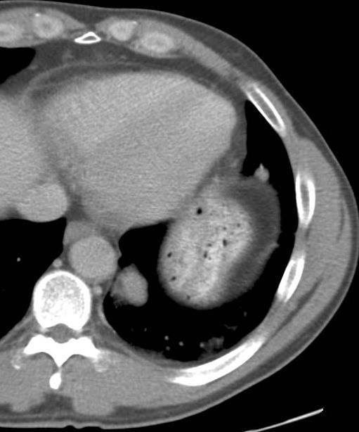 Spleen not visualized in LUQ abdomen Small