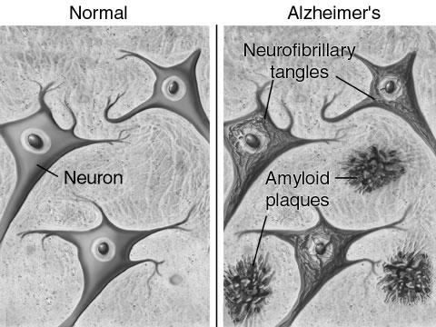 Misfolded proteins and disease Dementia associated with 2