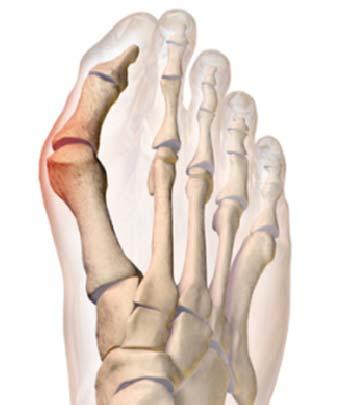 What is a bunion? A bunion is a bony lump on the side of your foot at the base of your big toe (see figure 1).