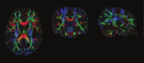each participant s data set the alignment of DTI and T1 images in the brain regions of interest.