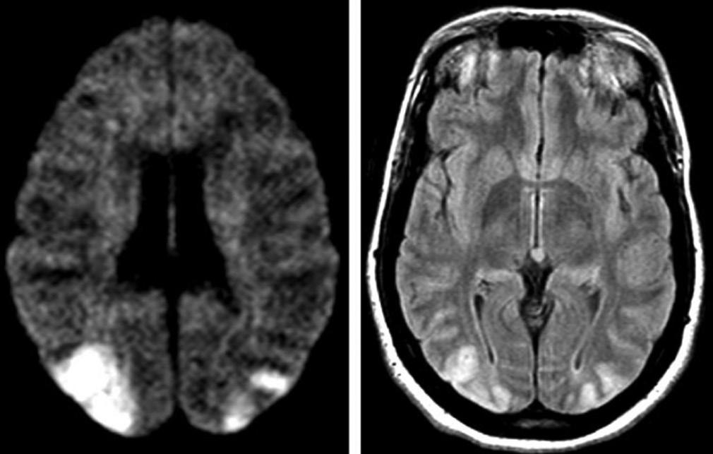 There is no documenttion of hzrdous fetl effects in humns due to the mgnetic field exposure. Ischemic stroke The most importnt leding cuse of mternl mortlity is stroke.