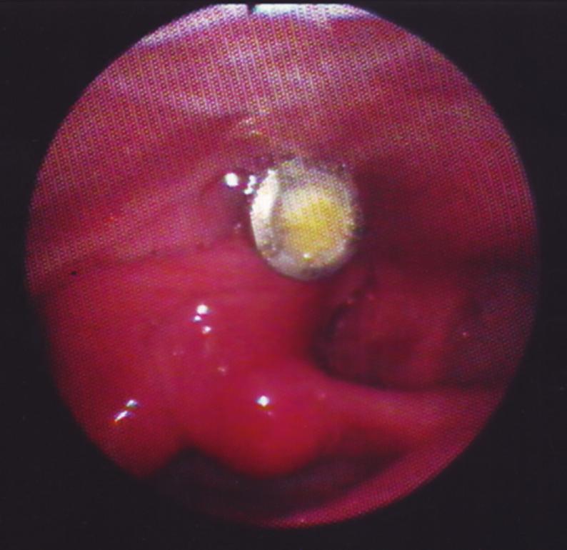 2 Case Reports in Otolaryngology Figure 1: At laryngoscopy, the upper part of the screw is clearly visible in the postcricoid area, just above the entrance of left