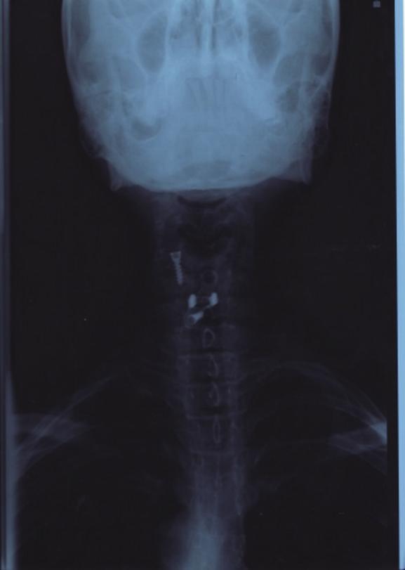 Figure 2: X-ray with contrast medium: the arrow clearly indicates the migration of the screw from the prosthesis in posteroanterior, right lateral, and left lateral