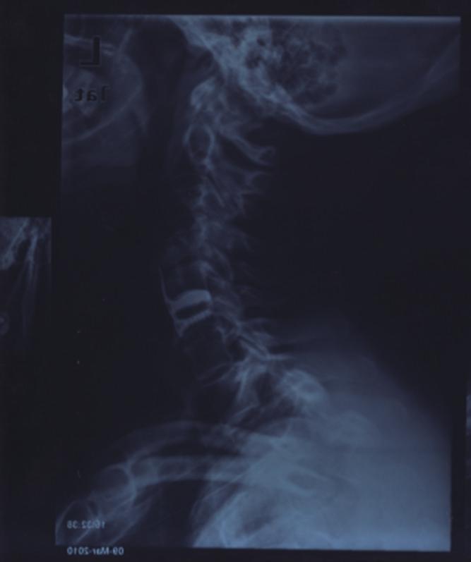 [11] reported a case of delayed screw migration in the gastrointestinal tract 11 years after the procedure, while in our case, the interval between surgery and the onset of symptoms was shorter,