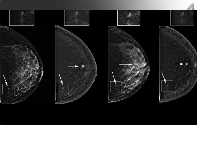 Conclusions Tomosynthesis is an exciting new technology that will likely revolutionize mammography.