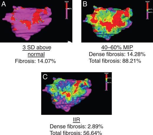 Figure 5 shows this same variability but with dense fibrosis, after an