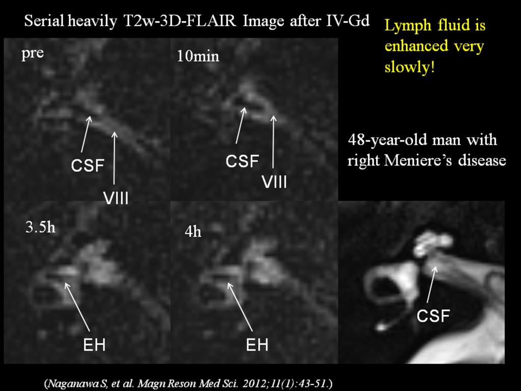 Double dose IV-Gd+3D-FLAIR, Acta Oto, 2010 # Single dose IV-Gd+heavily T2w-3D-FLAIR, MRMS, 2012 # HYDROPS image processing, MRMS, 2012 Images for this section: Fig.