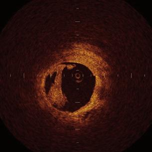 reported that lumen diameters at the proximal site of culprit lesions measured on TD-OCT images were almost identical to those measured with IVUS.