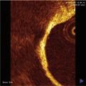 ultrasound showing plaque-rich long lesion. (A) Proximal reference site.