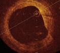 however, the limited resolution of IVUS makes it difficult to evaluate the extent or thickness