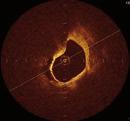 follow-up time is warranted to analyze how incomplete stent apposition and tissue prolapse