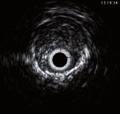 potential risk for late stent thrombosis (LST), a life-threatening complication, especially