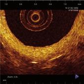stent implantation. PES at 6 months Figure 6.