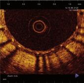 coherence tomography signal intensity and texture patterns are