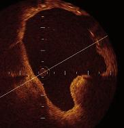 Conclusion Optical coherence tomography provides new insights into the assessment of coronary artery disease.