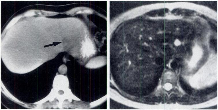 AJR:158, March 1992 CT OF SMALL HEPATIC LESIONS 537 Fig. 1.-Small hepatic hemangioma.
