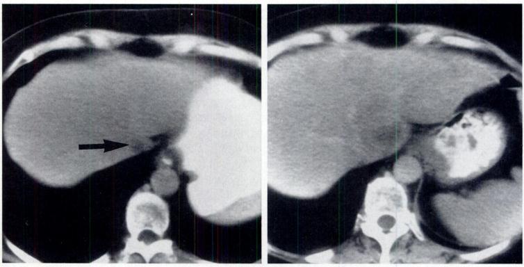 -A and B, CT scans obtained initially (A) and 1 year later (B) show stability of single lesion (arrows) in lateral