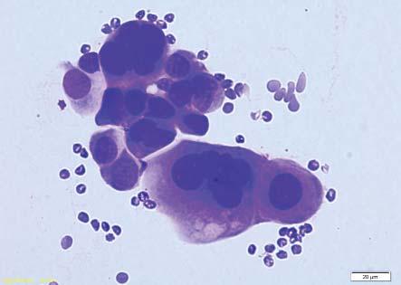 Mehotra R & Dhingra v: Cytological diagnosis of Sarcoidosis revisited: A state of the art review.