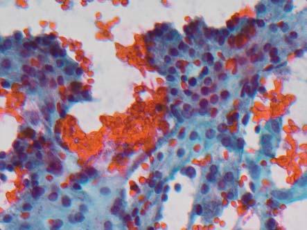 About 16% of cases of Acinic Cell Carcinoma metastasise to sites such as the lungs and bone 4. They may also reoccur if primary tumour removal is inadequate.