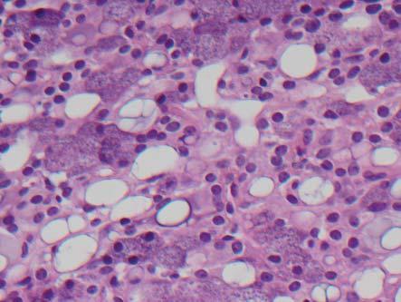 A lymphocytic infiltrate was also present (Fig 7). Based on these histological findings, a diagnosis of Acinic Cell Carcinoma was made.