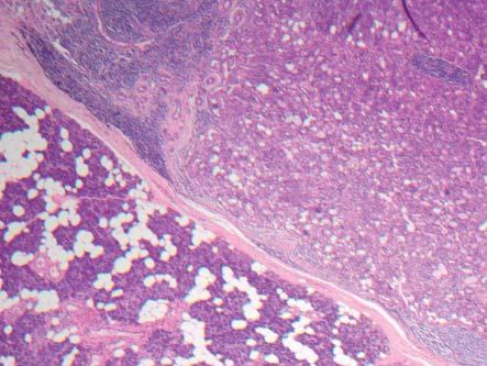A histology section of the right parotid glandular tissue with an encapsulated mass showing an extension of small tumour lobules into adjacent parotid parenchyma.