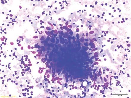 BAL - differential cell count 43% Lymphocytes with a CD4/CD8 ratio of 20:1. Fungal and Mycobacterial cultures on bronchial washings were negative. Angiotensin Converting Enzyme 56 U/L.