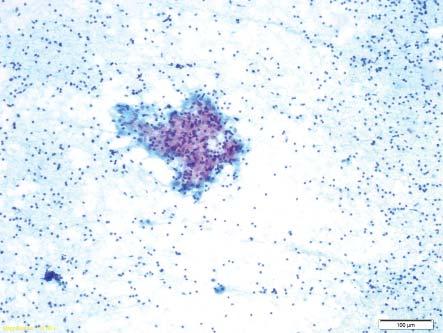 Figure 3a: A granuloma containing epithelioid histiocytes, macrophages, and lymphocytes - Case 2 (Pap x10) Figure 3b: High power view of the same granuloma highlighting the foot print outlines of the