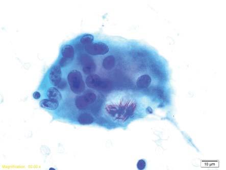 component) Epithelioid histiocytes elongated, elliptical, spindle shaped or curved nuclei nuclear outline described as footprint, boomerang, c or v shaped abundant cytoplasm with indistinct borders