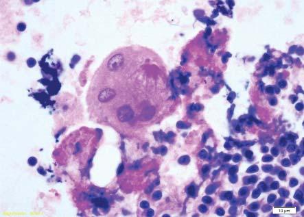 The early EBUS sampling of these lymph nodes resulted in numerous cytology slides being prepared.