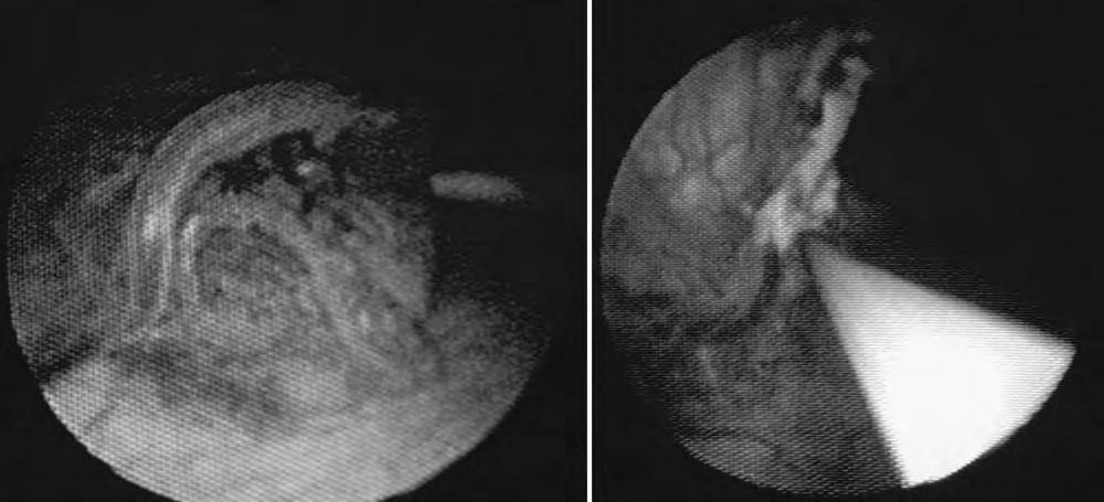 Endoscopic third ventriculostomy alone and combined with CPC FIG. 1. Left: Intraoperative endoscopic view of the CP in the right lateral ventricle just posterior to the foramen of Monro.