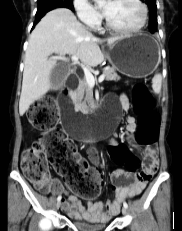 KIM ALS AFTER SUBTOTAL GASTRECTOMY Fig. 2 Abdominal CT findings of ALS in a 56-year-old woman. Afferent loop dilatation was found on CT during routine followup; however, she did not have any symptoms.