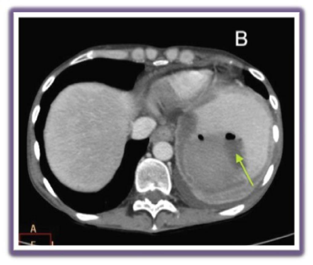 Fig. 10: A,B. 58-year-old man with abscess of left subphrenic space and left pleural efusión after total gastrectomy.