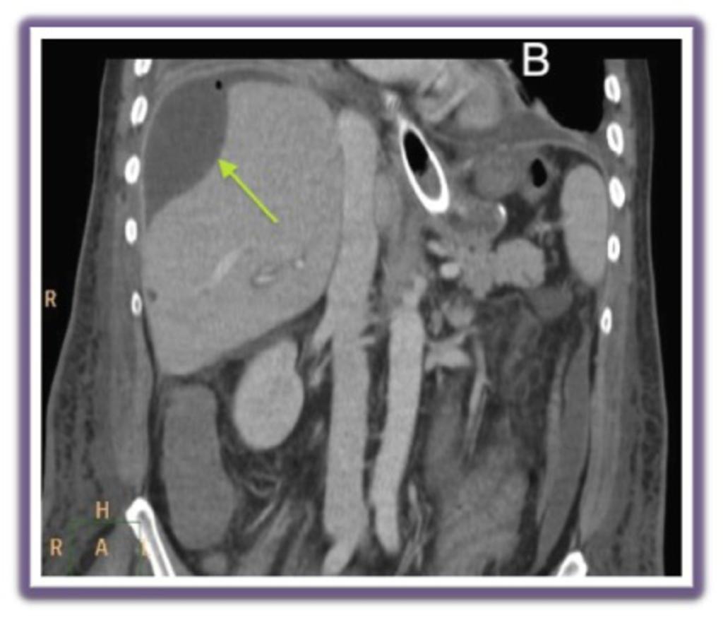 Fig. 12: 60-year-old man with a duodenal stump leakage after a total gastrectomy.