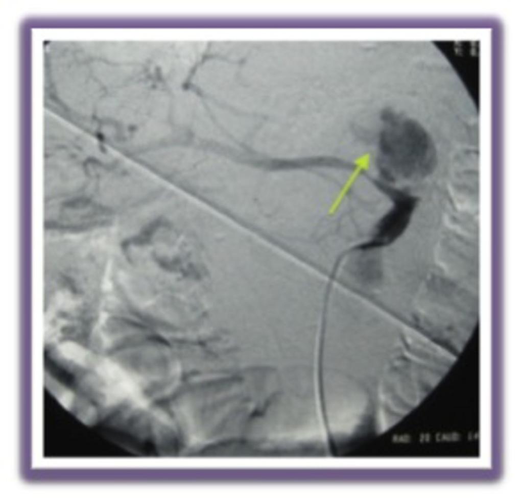 Fig. 16: Left gastric artery pseudoaneurysm in a 62-year-old man after the subtotal gastrectomy.