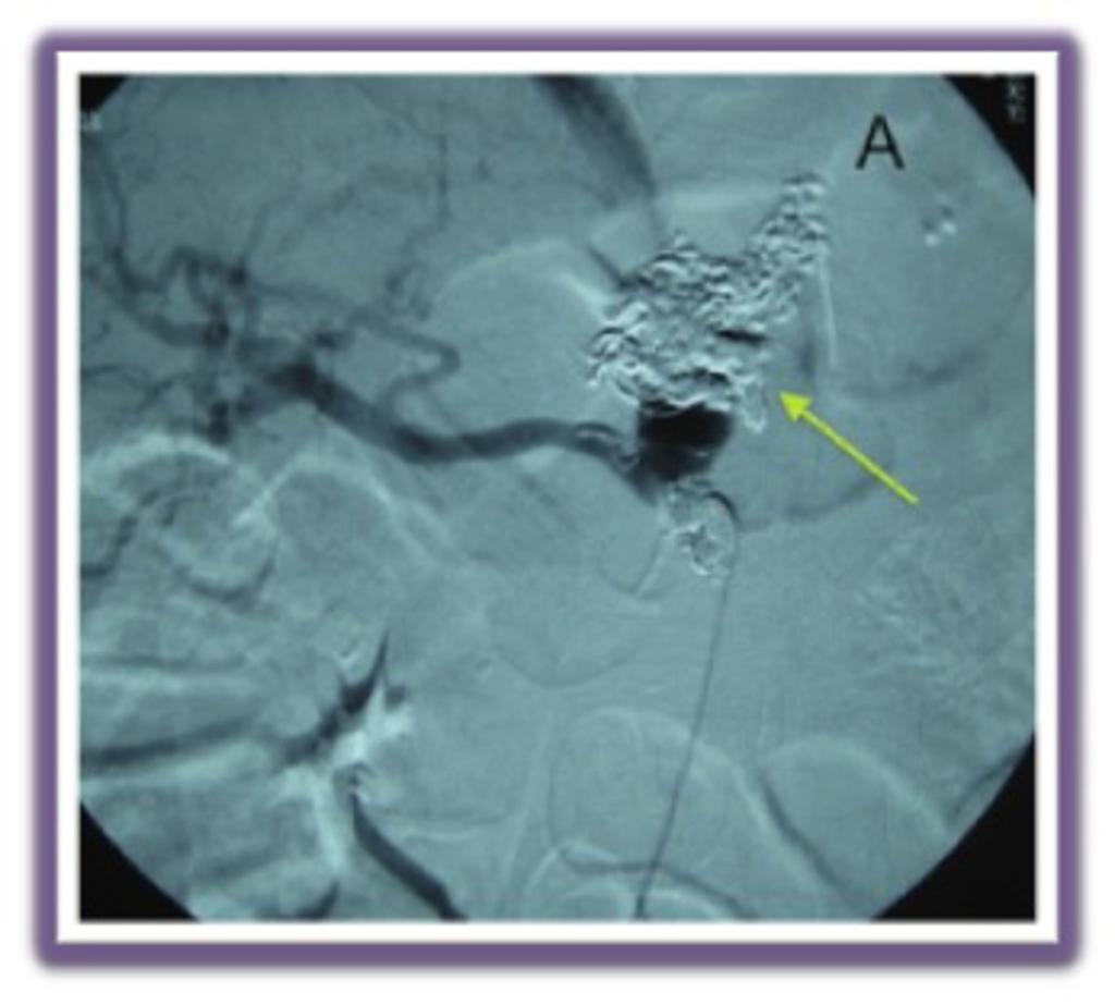 Fig. 17: Arteriography after coil embolization