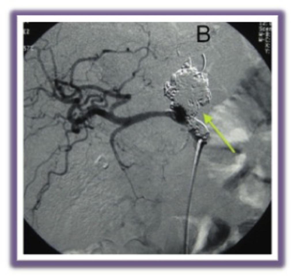 Fig. 18: Arteriography after coil embolization shows no filing of