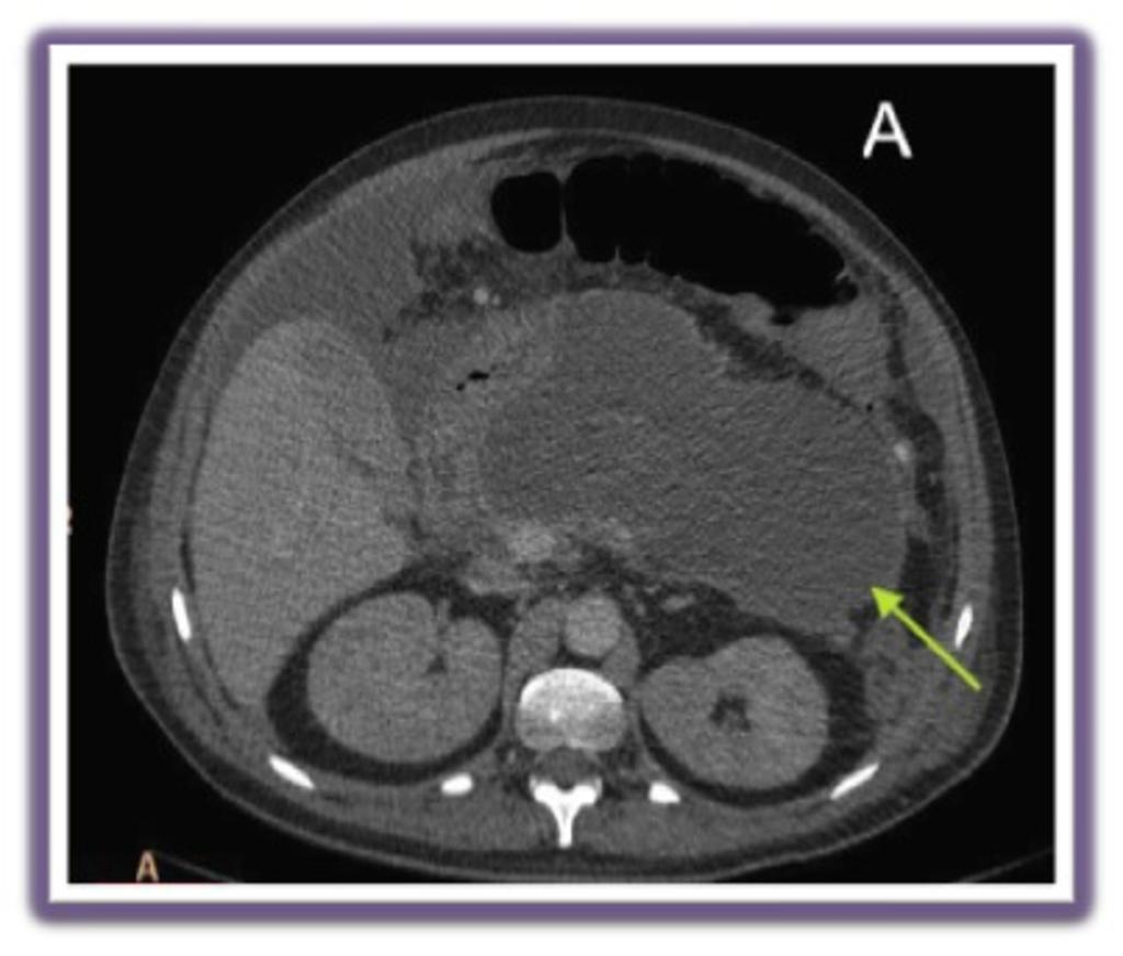 Fig. 19: Postoperative pancreatitis in a 57 year-old woman after the subtotal gastrectomy.