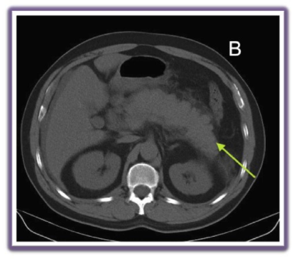 Fig. 20: Postoperative pancreatitis in a 57 year-old woman after the subtotal gastrectomy.