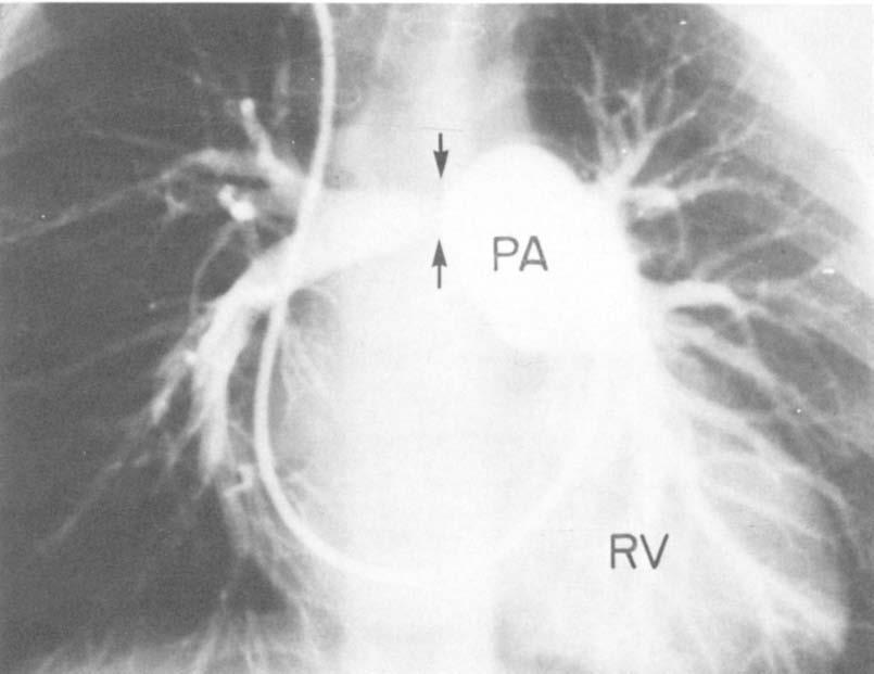 (PA = pulmonary artery; RV = right ventricle.) Ventricular Septa1 Defect Closure. The VSD was closed with a Teflon patch in 10 patients.