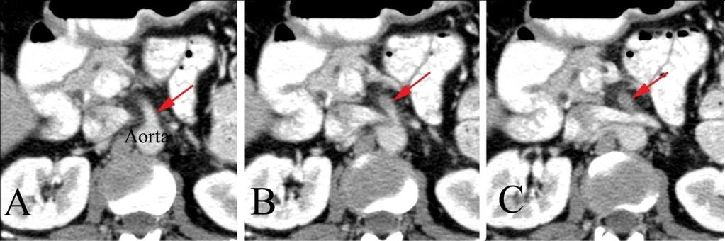 6/23/2012 Radiology Quiz of the Week #78 Page 5 PATIENT DISPOSITION, DIAGNOSIS, AND FOLLOW-UP Note that while the question refers to which study is best for evaluation of the abdominal arterial tree,