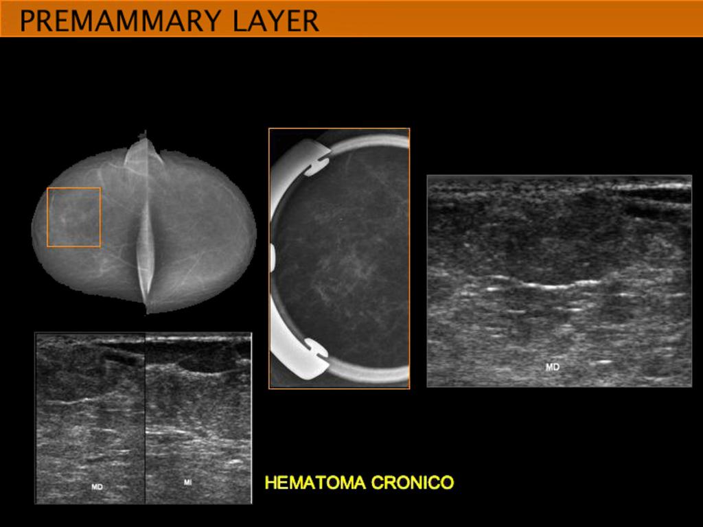 Fig. 12: CHRONIC HEMATOMA at us imaging a solid