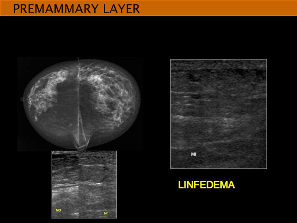 Fig. 17: UNILATERAL LYMPHEDEMA in a woman with chronic renal