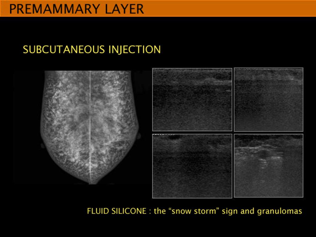 Fig. 22: SUBCUTANEOUS SILICONE INJECTION : at US imaging the