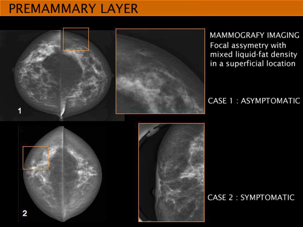 Conclusion Breast sonography plays an important role in evaluation of mammographic lesions such as masses and focal asymmetries, identifying fairly accurately their location; so that lesions arising