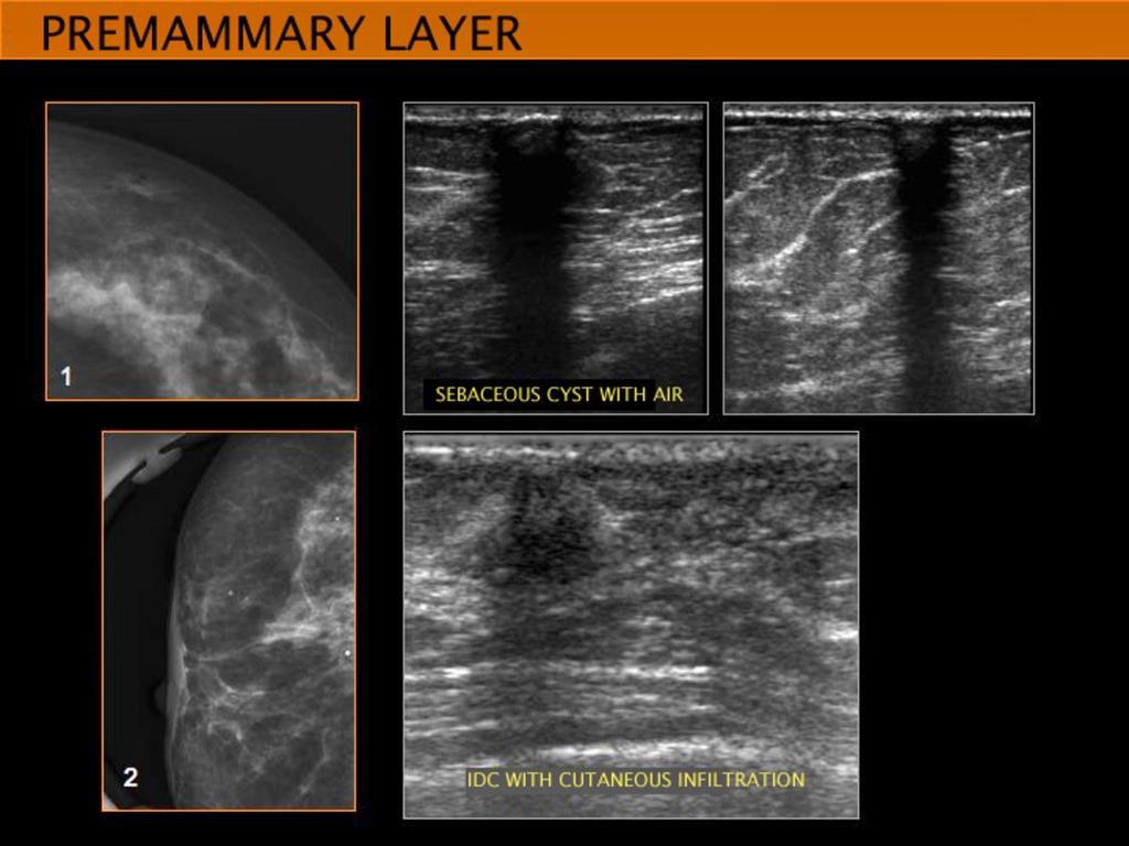 Fig. 24: MAMMOGRAPHY : SUPERFICIAL FOCAL ASSYMETRIES IN TWO DIFFERENT WOMEN ONE (case 1) ASYMPTOMATIC AND THE OTHER ONE (case2)with a palpable
