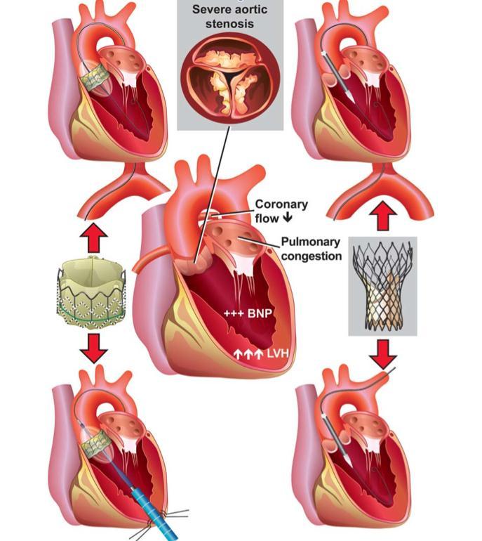 Trans-catheter aortic