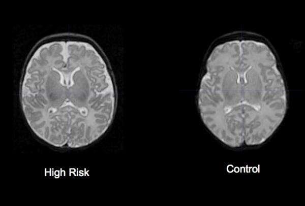 Brain signs of schizophrenia found in