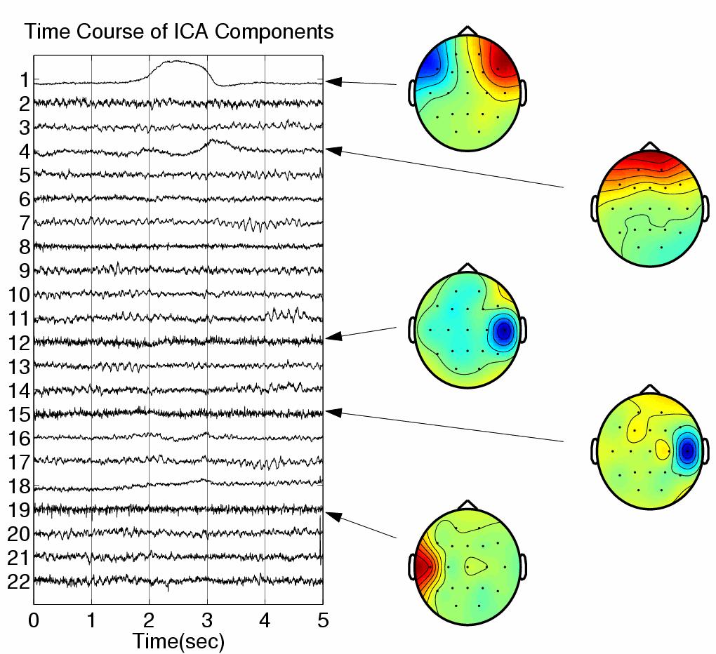 and muscle artifacts. The artifact-corrected data reveal underlying EEG activity at temporal sites T3 and T4 (Fig. 2C) that was well masked by muscle activity in the raw data (cf. Fig. 2A).