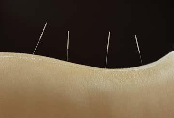 The data in the table illustrates that the number of acupuncture treatments is at least 30, and the frequency of treatments is daily or every other day, with short breaks of 2 or more days between